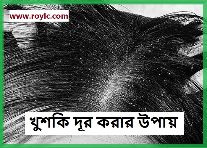 খুশকি দূর করার উপায়